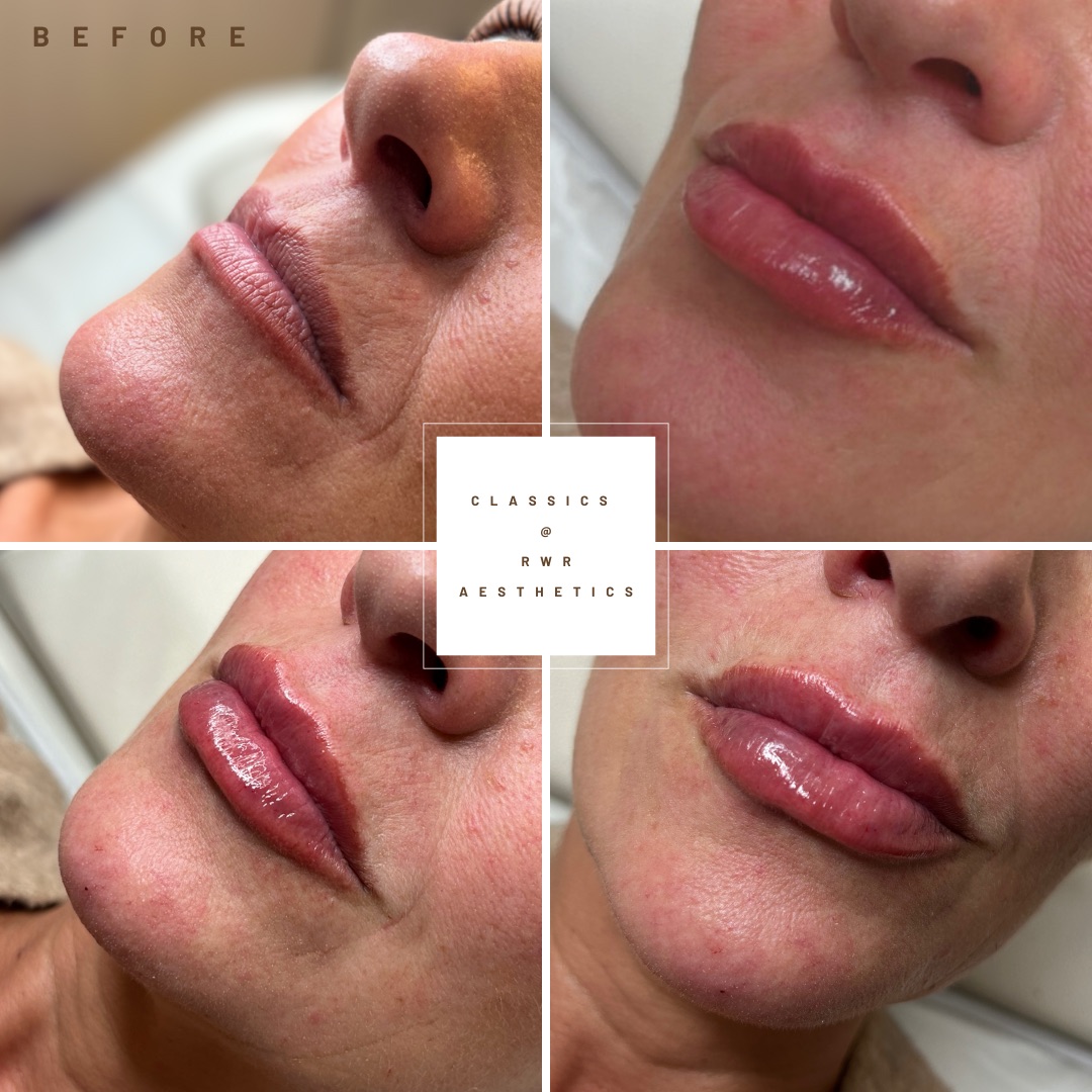 Four close-up photos of lips before and after filler, with a small Classics and RWR Aesthetics label in the centre