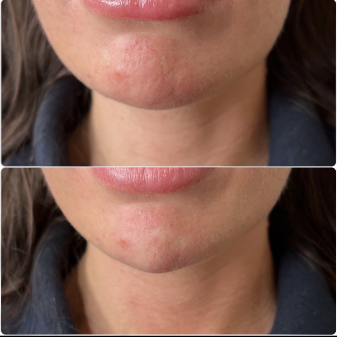 Two stacked close-ups of the chin and lips before and after treatment