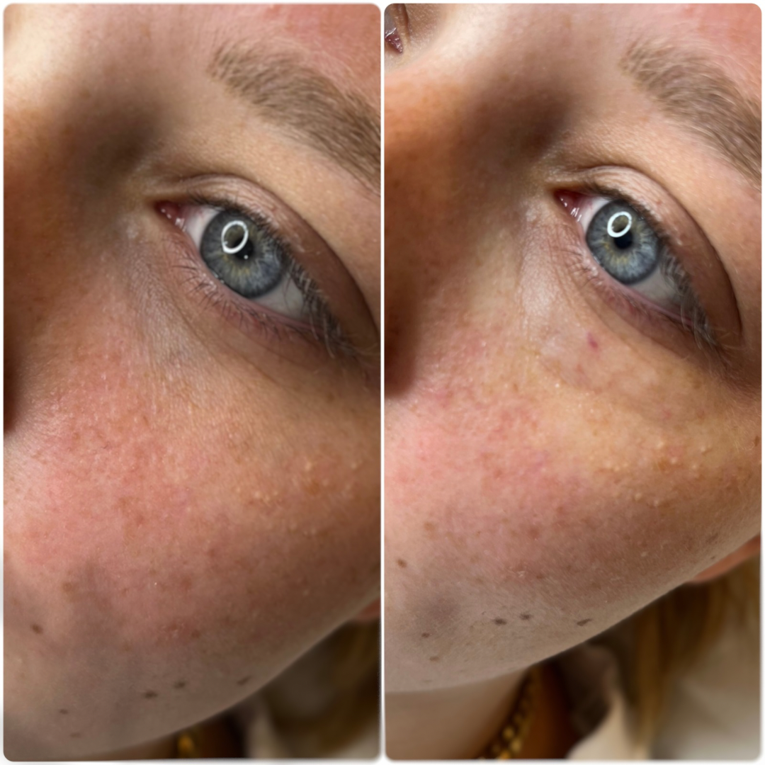Side by side close-ups of the eye area before and after treatment
