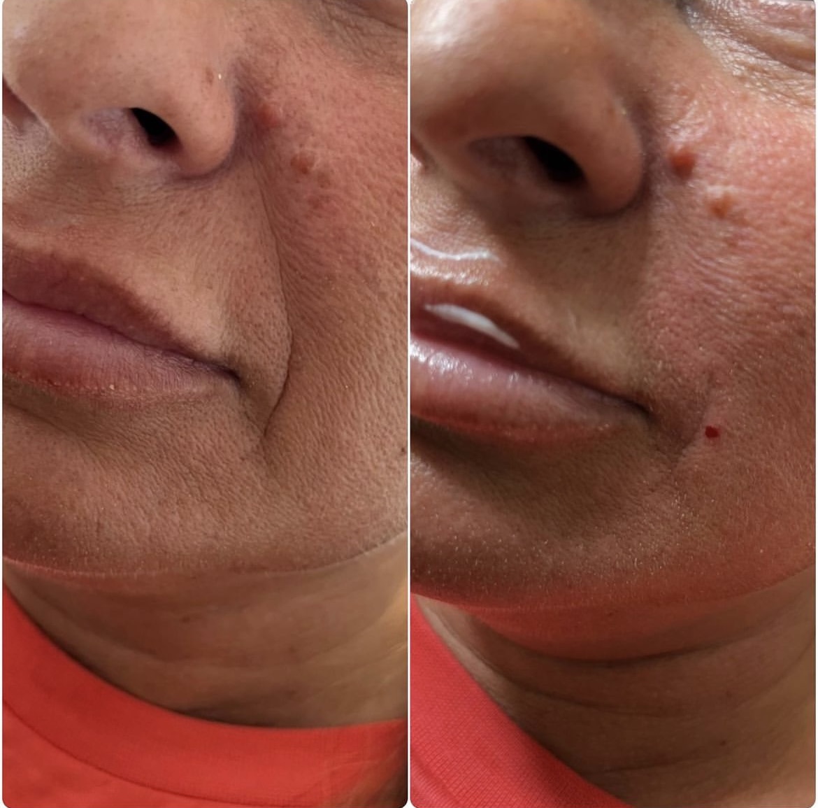 Side by side close-ups of the lower face and lips before and after treatment