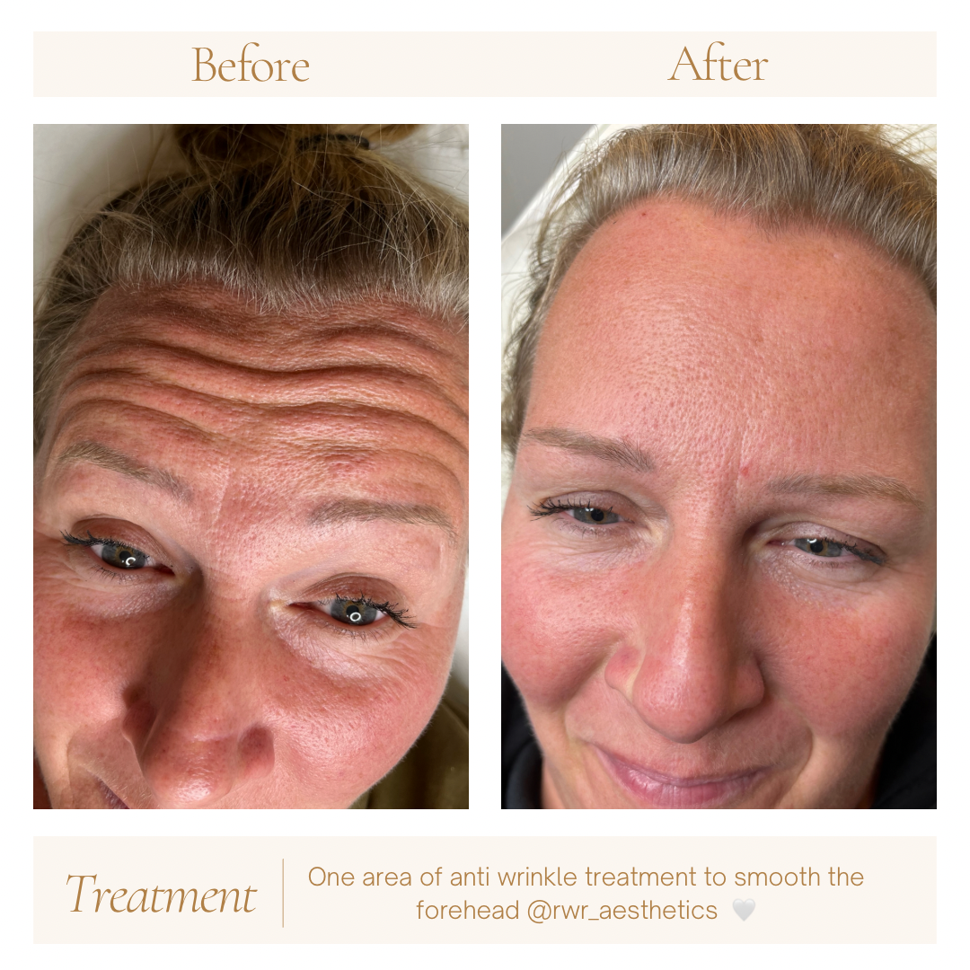 Before and after photos of a forehead, smoother after treatment