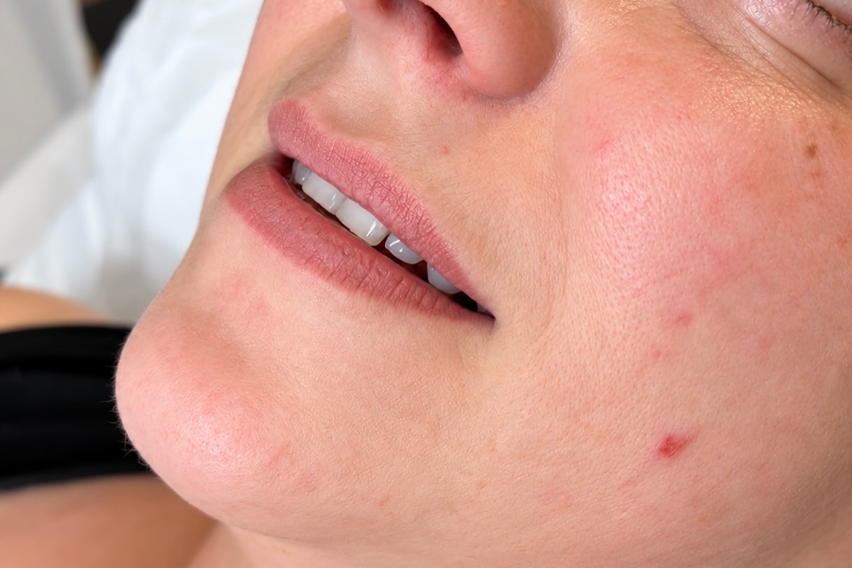 Close-up of softly defined lips after treatment